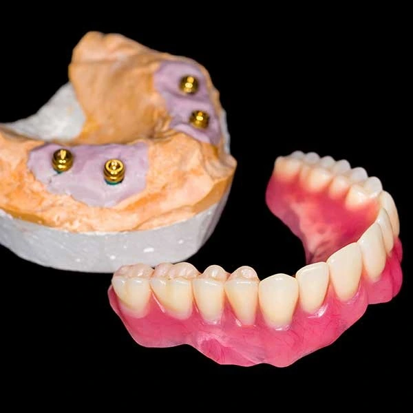 Dental Implant Cost Per Tooth